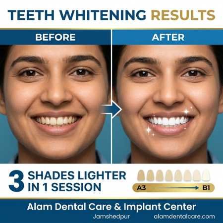 Before and after teeth whitening patient 1 - 3 shades lighter in 1 session