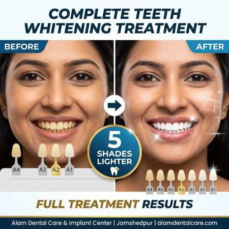 Before and after teeth whitening patient 2 - 5 shades improvement after complete treatment